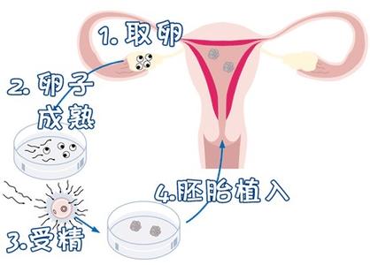 卵子凍結保存